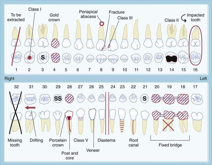 Traditional odontogram chart showing dental findings notation