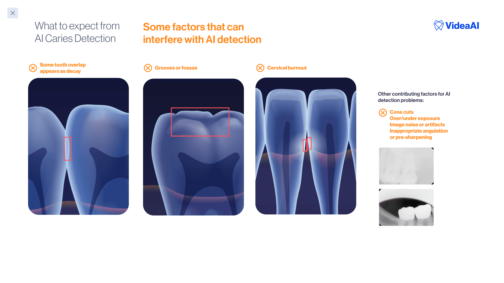 Onboarding slide — AI caries detection explained with 3D tooth illustration